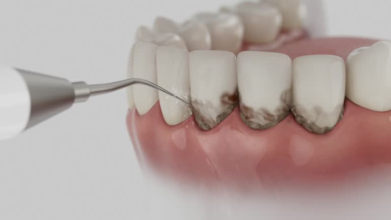 Trusted Wisdom Tooth Removal service in Rancho Calaveras, CA - Dentist Open Now